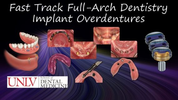 Fast Track Full-Arch Dentistry Implant Overdentures